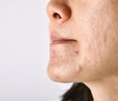 Protecting Your Skin: Tips from Dermatologists for Sun Safety