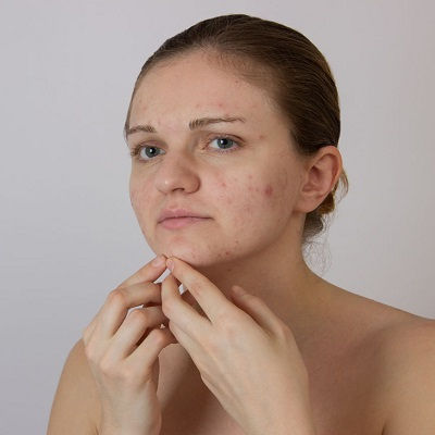 Acne Scar Treatment Clinic in Oman