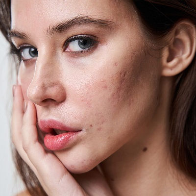 Acne Scar Treatment Clinic in Oman