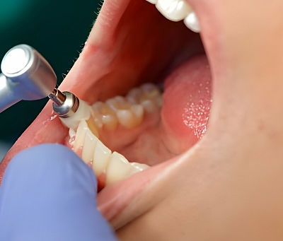 Dental Stains Removal for Teens Explained