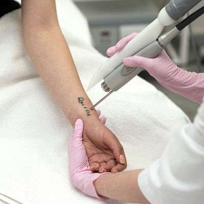 Laser Tattoo Removal Clinic in Oman