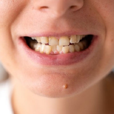 Overlapping Teeth Treatment in Dubai