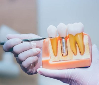 What Happens If You Don't Replace Missing Teeth with Implants?