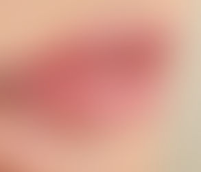 What Makes JUVÉDERM VOLBELLA Different from JUVÉDERM VOLUMA?