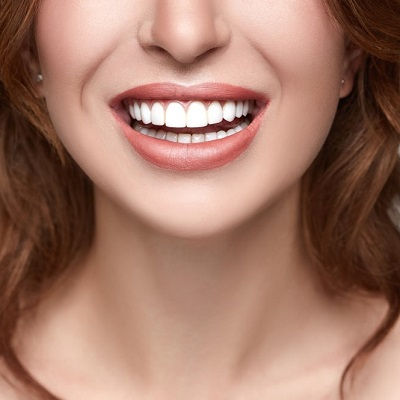 Emax Veneers Dubai Price