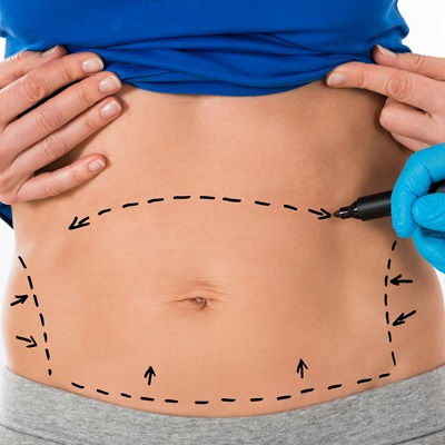 نتائج عملية شد البطن: ما مدى طبيعية مظهرها؟