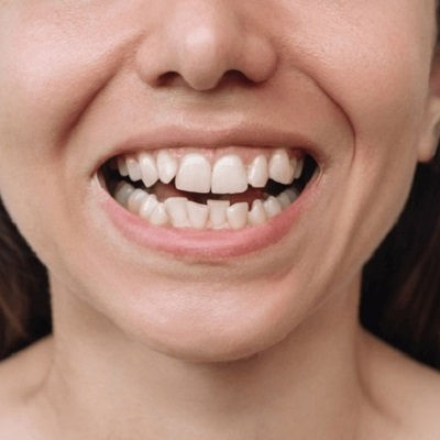 Crowded Teeth Treatment in Dubai