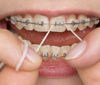 Can You Get Braces with Sensitive Teeth?