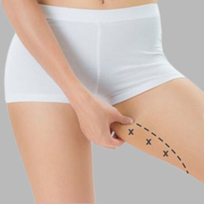 Best Thigh Lift in Oman