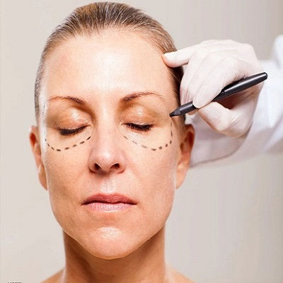 Best Eyelid Surgery Muscat