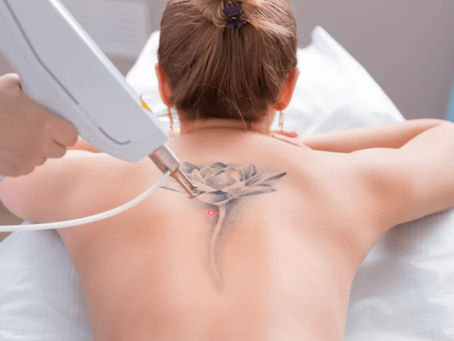 Does Laser Tattoo Removal Leave Scars?