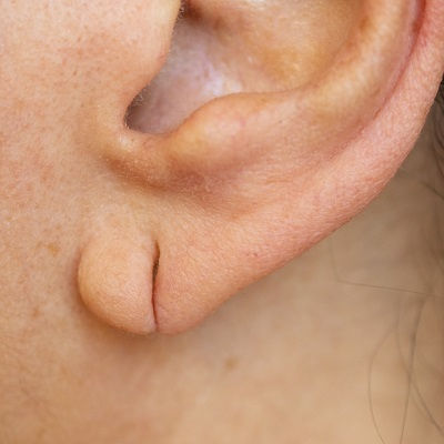Earlobe Correction Surgery Oman