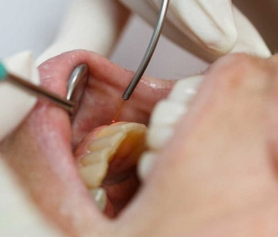 Gum Tissue Removal: Do Gums Regrow Again?