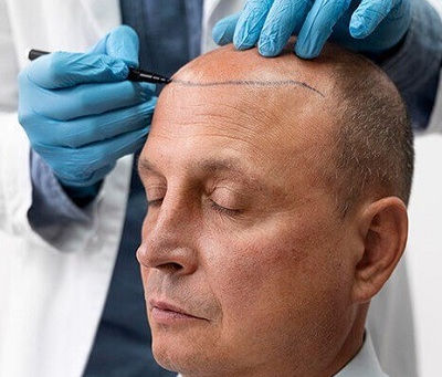 Why More Men Are Choosing Hair Transplants Than Ever Before