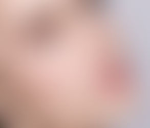 Cheek Fillers vs. Contouring: What Works Better?