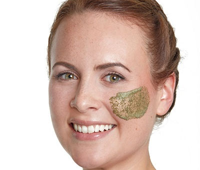 What Is Green Peel and How Does It Work?