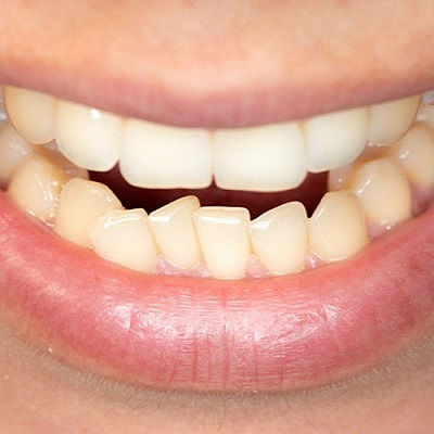 Best Crowded Teeth Treatment in Dubai