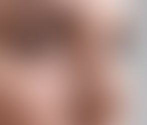 شرح جراحة تجميل الأنف والتقنيات التي لا تترك ندوباً