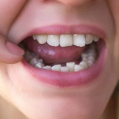 Best Crowded Teeth Treatment in Dubai