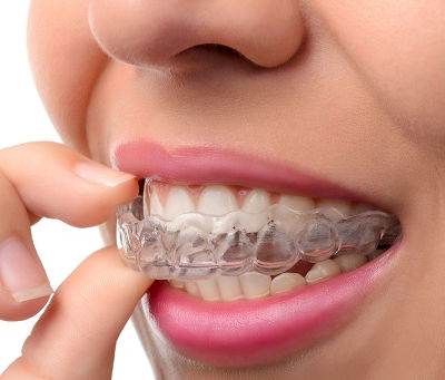 The Psychological Effects of Overlapping Teeth in Dubai