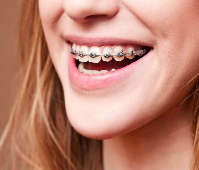How Dental Braces Can Improve Jaw Alignment