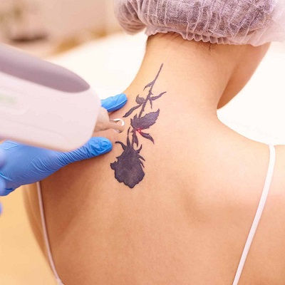 Best Laser Tattoo Removal Muscat