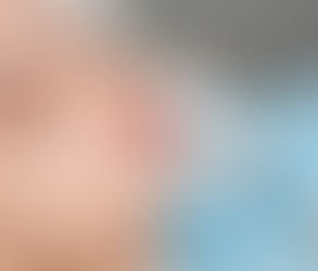Are Lip Fillers Considered Plastic Surgery?