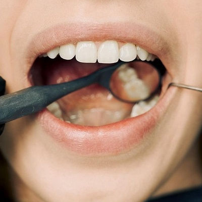 Best Tooth Removal in Dubai