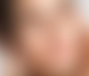 حقن الحشوات الجلدية لتنعيم الخطوط الدقيقة