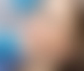 Posterior Root Canal After Tooth Whitening