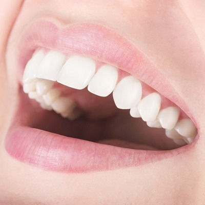 Best Overlapping Teeth Treatment in Dubai