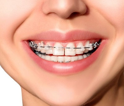 Dental Braces: A Step-by-Step Guide