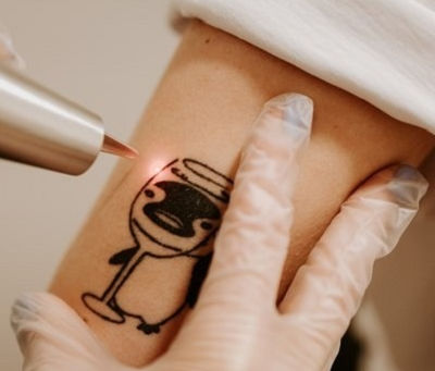 How to Care for Your Skin After Laser Tattoo Removal