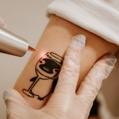 Best Laser Tattoo Removal in Oman