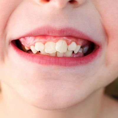 Crowded Teeth Treatment Dubai