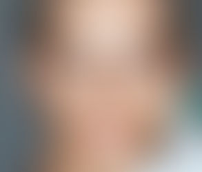 Profhilo for Men in Muscat: A Modern Solution for Youthful Skin