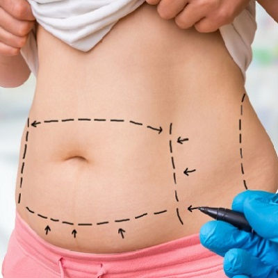 Vaser 4D Liposuction Clinic in Muscat
