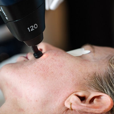 Best Fractional Co2 Treatment Oman