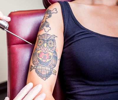 What You Should Know Before Getting Laser Tattoo Removal