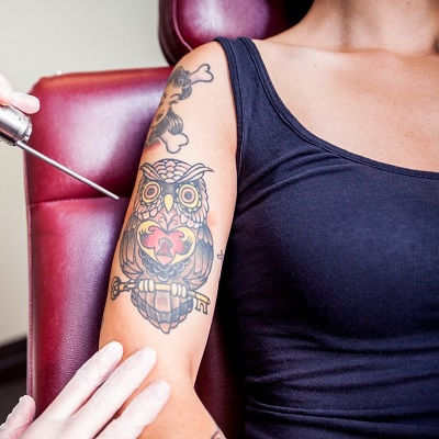 Laser Tattoo Removal Muscat