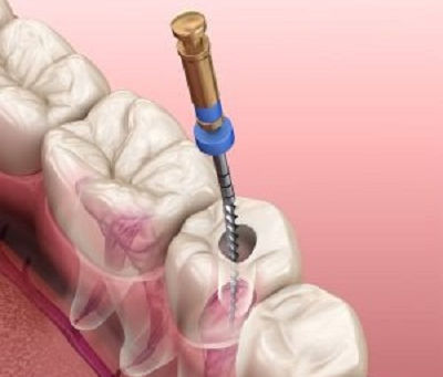 Advanced Tools and Techniques Used by Dubai’s Leading Endodontists