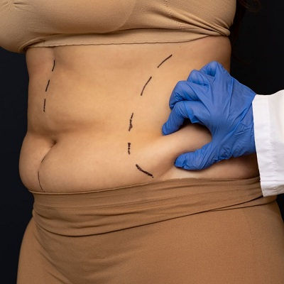 شفط الدهون مسقط