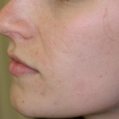 Best Acne Scar Treatment in Oman
