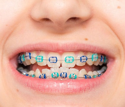 The Benefits of Dental Braces for Adults in Dubai