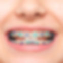 Metal vs Ceramic Teeth Braces: Which Is Better?