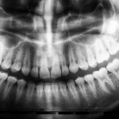 Dental Panoramic X-Ray in Dubai