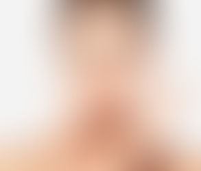 How JUVÉDERM Voluma Affects Facial Expressions