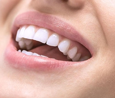 Teeth Whitening for Older Adults: What You Should Consider