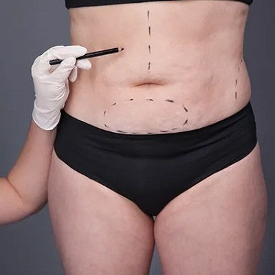 Vaser 4D Liposuction Oman