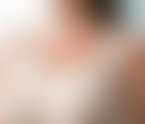 نتائج جراحة تصغير الثدي: ما يمكن توقعه